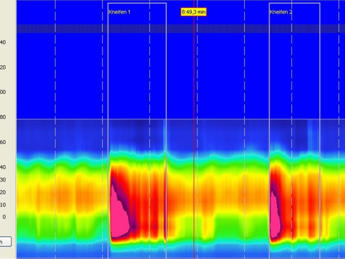 Vivomed-Gastroenterologie-Bern-3D-high-resolution-Anorektale-Manometrie-Ruhedruck-und-Kneifdruck